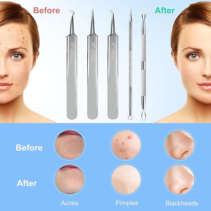 Blackhead Remover Tweezers, Pimple Popper Tool Kit, Ingrown Hair Tweezers, Blackhead Extractor, Skin Zit Acne Blemish Popping Removing Surgical Tweezers Tools for Nose Eye Face