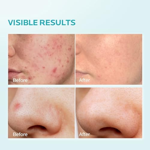 ZealSea 10% Azelaic Acid Facial Cream - Azelaic Acid Serum with AHA for Face, Relief Pimple, Breakouts, Blackhead & Redness, Azelaic Acid Gel Clarify Skin Soothe Irritation, 0.34 Oz Travel Size