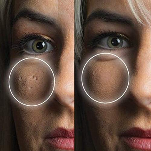 Dermaflage Scar Filler Kit - Porcelain - Deep Scar Cover and Waterproof Concealer for Acne Scars Wrinkles, and Ice Pick Scars Makeup, 1 mo supply