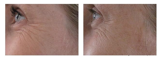 Airelle Age-Defying Eye and Lip Treatment | Anti Aging, Helps Reduce Wrinkles, Fine Lines | Dermatologist Recommended | Hyaluronic Acid, Berrimatrix | Natural Ingredients | .3 Fl Oz