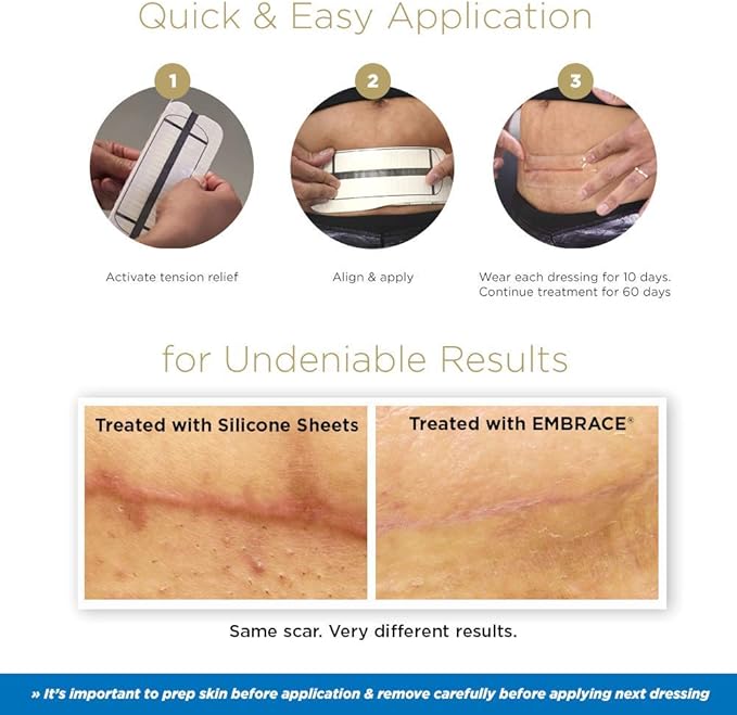 Embrace Active Scar Defense for New Scars, FDA-Cleared Medical-Grade Silicone Scar Sheets for Hypertrophic & Keloid Scar Treatment, 4.7 Inch, Large, 30-Day Supply
