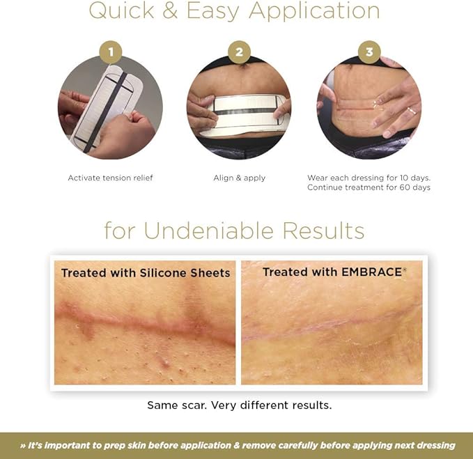 Embrace Active Scar Defense for New Scars, FDA-Cleared Medical-Grade Silicone Scar Sheets for Hypertrophic & Keloid Scar Treatment, 6.3 Inch, Extra-Large, 30-Day Supply