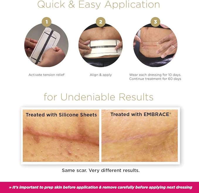 Embrace Active Scar Defense for New Scars, FDA-Cleared Silicone Scar Sheets, 2.4 Inch, Medium, 60 Day Supply (Recommended Treatment)