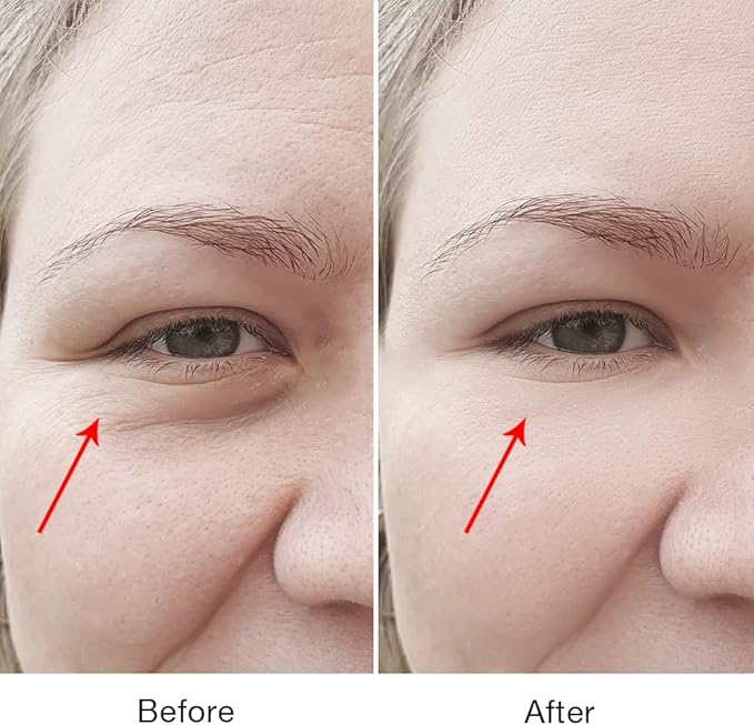 Puffy Eyes Treatment | Eye Puffiness | Eye Bags | Crows Feet | Fine Line Reducing - TS-Lifter Technology(Minor Stings) + Radio Frequency - 2 in 1 Professional RF Eye Anti Aging Device