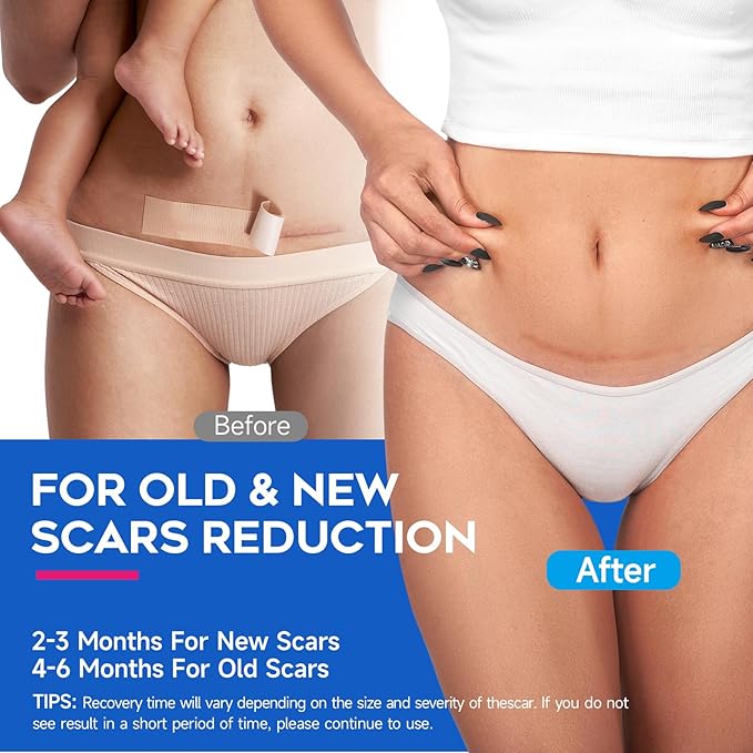 Thicker Silicone Scar Sheets, Medical Grade