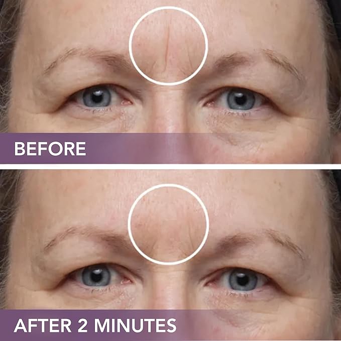 Dermaflage Scar Filler Kit - Dark - Deep Scar Cover and Waterproof Concealer for Acne Scars Wrinkles, and Ice Pick Scars Makeup, 1 mo supply