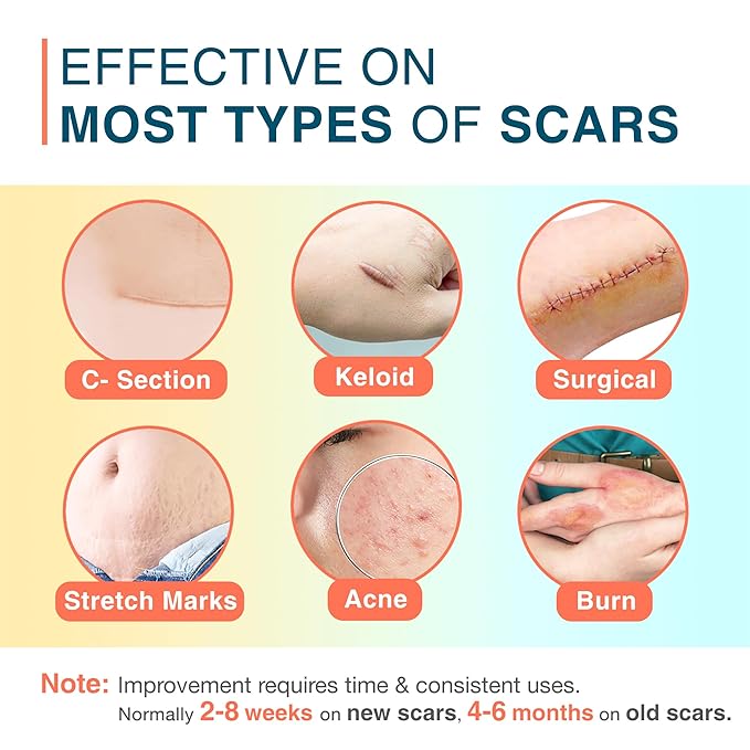 Silicone Scar Sheets, 1.5¡± x 78¡±