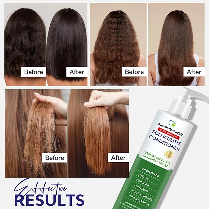 Folliculitis Itch Relief Conditioner: Tea Tree Oil & Moroccan Argan Oil - Deep Hydration & Repair - Nourishes, Smooths, Restores Shine - Safe for Dry or Damaged Hair-11.84 oz