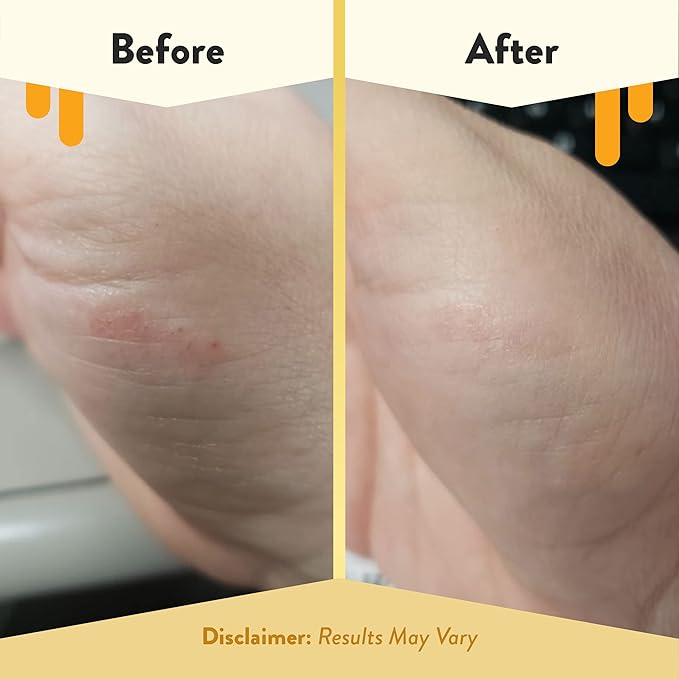 Eczema honey itch cooling face