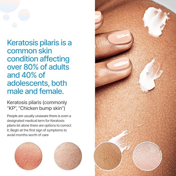 KP Essentials - Keratosis Pilaris Exfoliating Cream - Clear Red Bumps on Thighs and Arms For Confident Clear Skin - 4oz (1 Bottle)