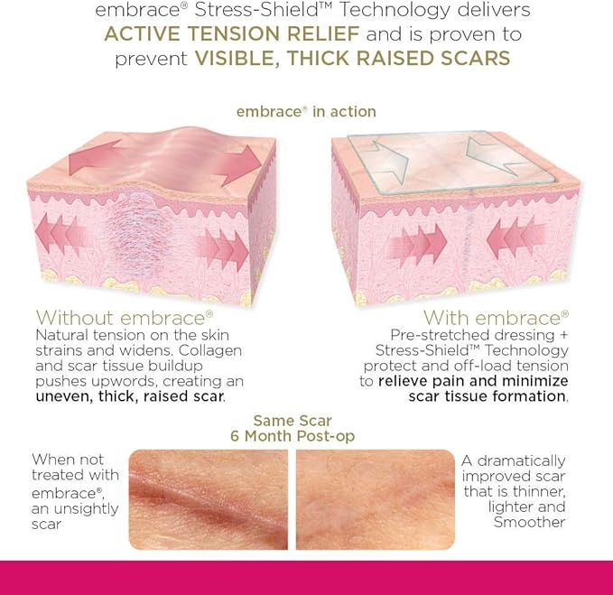 Embrace Active Scar Defense for New Scars, FDA-Cleared Silicone Scar Sheets, 2.4 Inch, Medium, 60 Day Supply (Recommended Treatment)