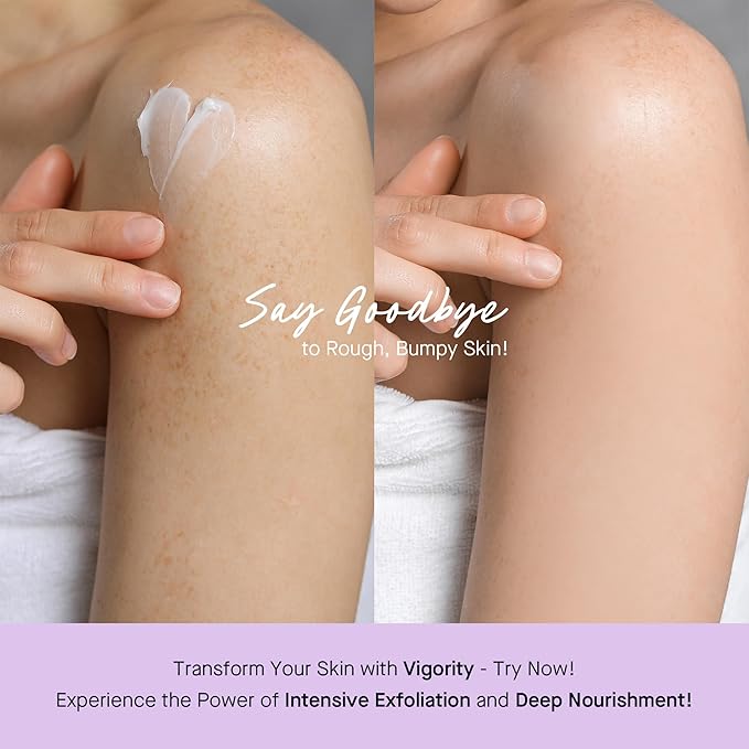 Vigority Keratosis Pilaris Treatment Cream with Lactic Acid – KP Body Bump Exfoliating Moisturizer for Rough, Bumpy, Dry & Flakey Skin, Strawberry Legs – 5.1 Oz