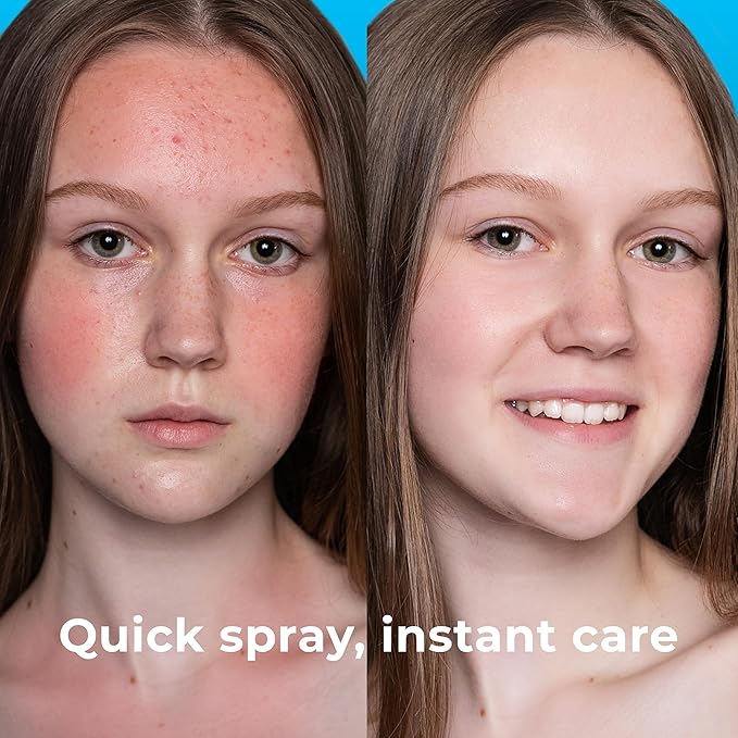 Hypochlorous Acid Spray (8oz, Reduces Acne), Targets Bacteria - HOCL Facial Cleanser Acne Spray for Face, Body, Eczema, Pimples, Breakouts & Overall Skin Recovery (Reduces Redness)