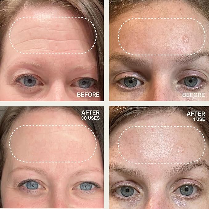 Dermaclara Silicone Facial Patches - Anti-Wrinkle Face Patches for Frown, Smile Lines & Forehead, Reusable Overnight Silicone Wrinkle Pads, Up to 30 Uses - 4 Under Eye Patches & 1 Forehead Patch