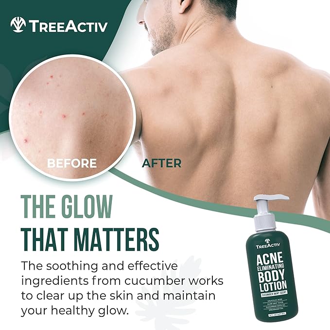 TreeActiv Acne Eliminating Body Lotion 8 fl oz | Clears Body, Back, Butt and Shoulder Acne | Anti-Acne Moisturizer | Prevents Future Breakouts | Cucumber Mint Scent