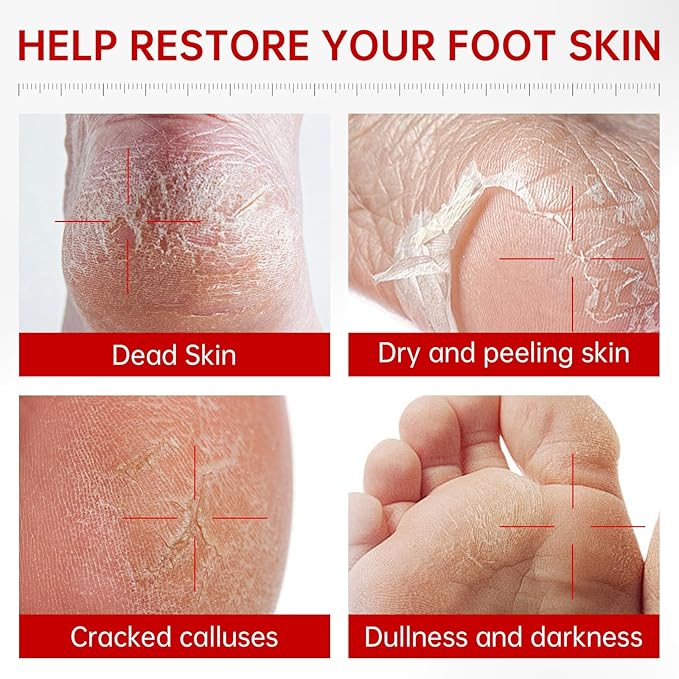 3 Pack Foot Peeling Mask, Hydrating Exfoliating Foot Mask for Dry Cracked Feet, Callus Remover & Cracked Heel Repair & Foot Care