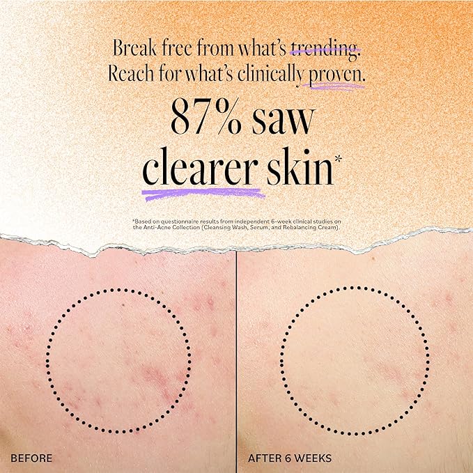 DERMA E Acne Oil Control Face Moisturizer, 2 Oz, Matte Moisturizer with Salicylic Acid, Tea Tree Oil & Aloe Vera, Face Cream Rebalances Sebum Production & Prevents Blemishes, Redness & Breakouts 2 Oz