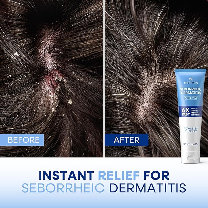 Seborrheic Dermatitis Scalp Treatment Cream: Soothing Itching Redness Scaling of Seborrheic Dermatitis - Fast-Acting Anti-Itch Ointment for Scalp Face Chest and Body for Men and Women 1 Pack